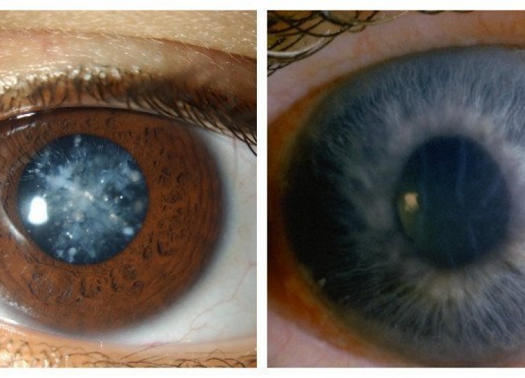 Катаракта глаза лучшие хрусталики. Глазные болезни: глаукома, катаракта. Факолитическая катаракта. Катаракта куриная слепота. Кольцевидная катаракта Фоссиуса.